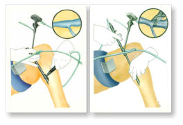 Airbrush und Mischtechnik / Endoskopische Operation, 1989  